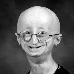 Sam Berns died at the age of 17 due to progeria.